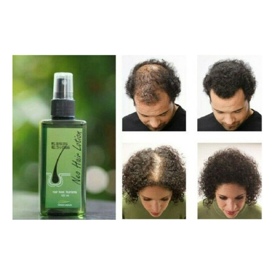 Neo Hair Lotion Natural Treatment For Hair Loss & Regrowth For Men & Women 120ml